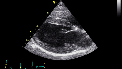 Thumbnail for Echocardiography: Clip 1