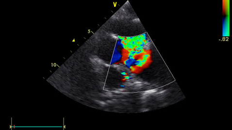 Thumbnail for Echocardiography: Clip 26