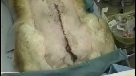 Thumbnail for Penile amputation