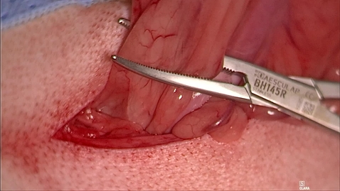 Thumbnail for Breaking the suspensory ligament