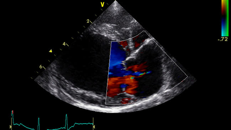 Thumbnail for Echocardiography: Clip 5