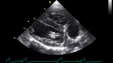 Thumbnail for entry Echocardiography: Clip 21