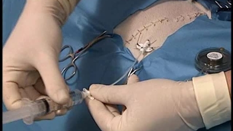 Thumbnail for Inserting a diffusion catheter