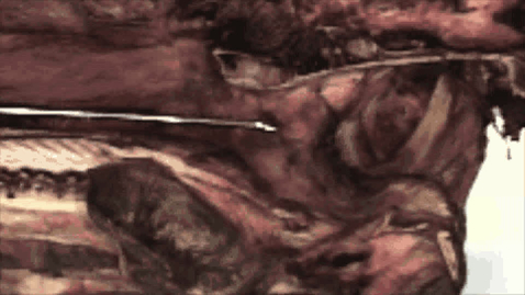 Thumbnail for URT endoscopy in the horse: Rotating the catheter in to the guttural pouch