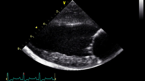 Thumbnail for entry Echocardiography: Clip 14