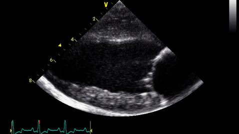 Thumbnail for Echocardiography: Clip 14