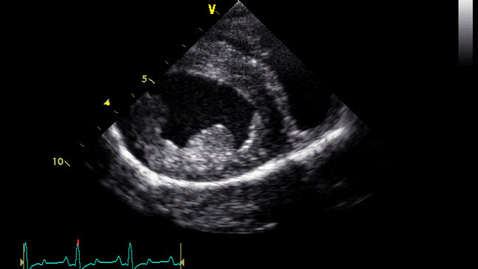 Thumbnail for entry Echocardiography: Clip 16