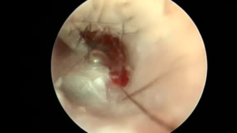 Thumbnail for Otitis: Bubbles from a ruptured drum