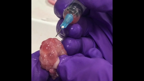 Thumbnail for Oocyte aspiration