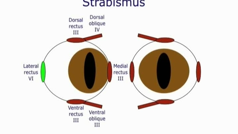 Thumbnail for entry Strabismus