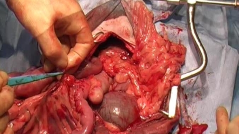 Thumbnail for entry Performing a mesenteric lymph node biopsy