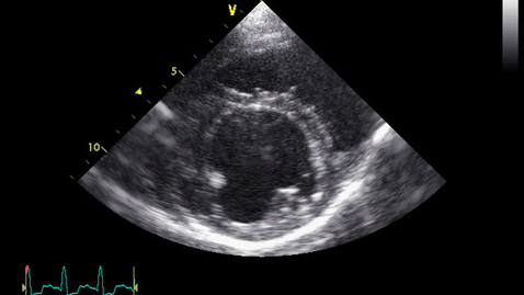 Thumbnail for entry Echocardiography: Clip 17