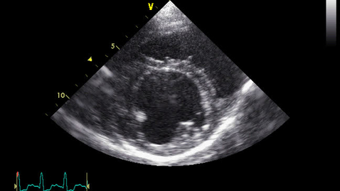Thumbnail for Echocardiography: Clip 17