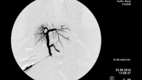 Thumbnail for entry Using a contrast agent to visualise vasculature