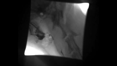 Thumbnail for Upper GI imaging: Clip 4