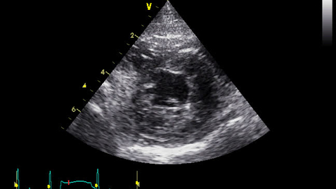 Thumbnail for Echocardiography: Clip 2