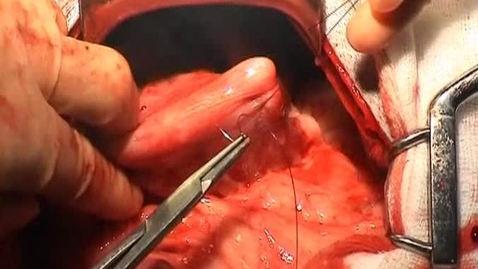 Thumbnail for entry Performing a gastric biopsy