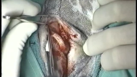 Thumbnail for Episiotomy