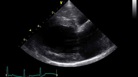 Thumbnail for entry Echocardiography: Clip 9