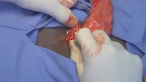 Thumbnail for Ovariohysterectomy in the bitch: Pedicle ligation