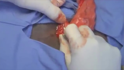 Thumbnail for entry Ovariohysterectomy in the bitch: Pedicle ligation