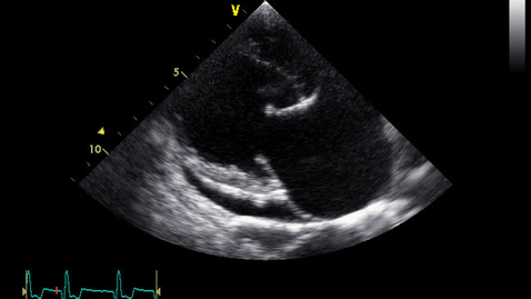 Thumbnail for entry Echocardiography: Clip 3