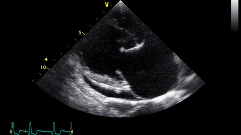 Thumbnail for Echocardiography: Clip 3