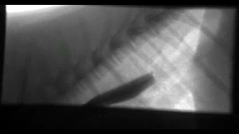 Thumbnail for Upper GI imaging:  Clip 3