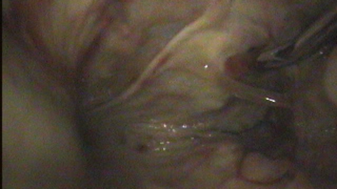 Thumbnail for URT endoscopy in the horse: Incorrect positioning of the catheter in to the dorsal pharyngeal recess: Clip 2