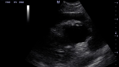 Thumbnail for Echocardiography: Clip 19