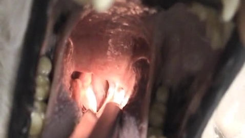 Thumbnail for Post-operative laryngoscopy
