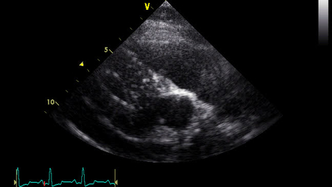 Thumbnail for entry Echocardiography: Clip 27