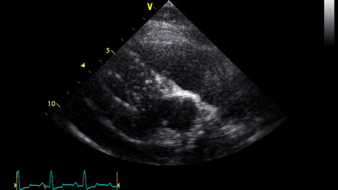 Thumbnail for Echocardiography: Clip 27