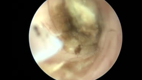 Thumbnail for entry Otitis: Moving an obstruction