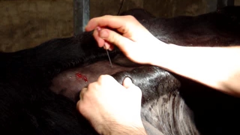 Thumbnail for Performing a paravertebral block at L2