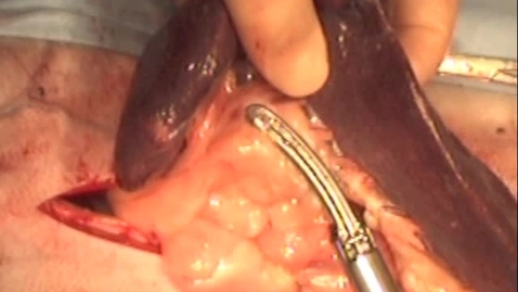 Thumbnail for Performing a splenectomy using an enseal super jaw device