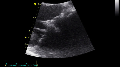 Thumbnail for entry Echocardiography: Clip 13