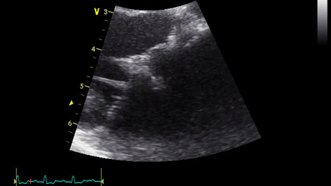 Thumbnail for Echocardiography: Clip 13