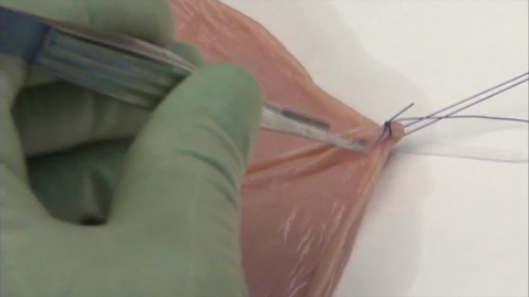 Thumbnail for Using an interrupted suture to perform an end to end anastomosis of the bowel