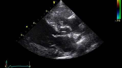 Thumbnail for entry Echocardiography: Clip 20