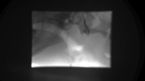 Thumbnail for Pre-operative laryngoscopy showing nasophargeal collapse in the bulldog