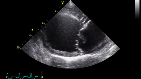 Thumbnail for entry Echocardiography: Clip 6