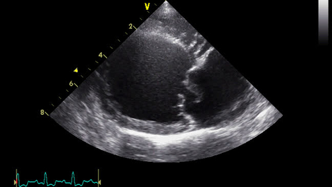 Thumbnail for Echocardiography: Clip 6