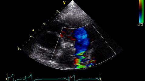 Thumbnail for entry Echocardiography: Clip 23
