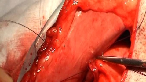 Thumbnail for Performing a belt-loop gastropexy