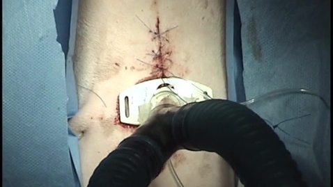 Thumbnail for Placing a temporary tracheostomy tube in the dog