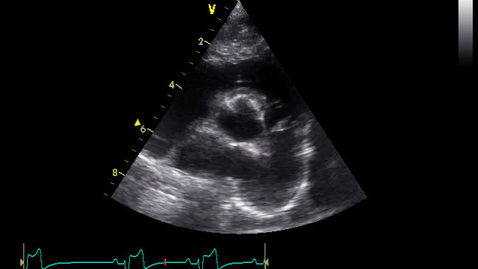 Thumbnail for Echocardiography: Clip 22