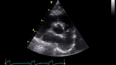 Thumbnail for entry Echocardiography: Clip 22