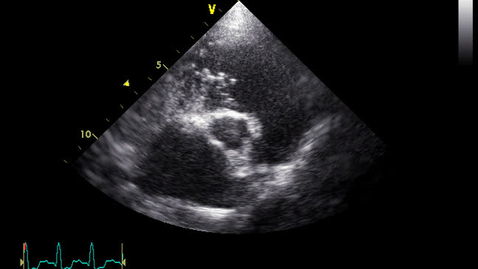 Thumbnail for entry Echocardiography: Clip 18