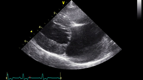 Thumbnail for entry Echocardiography: Clip 10